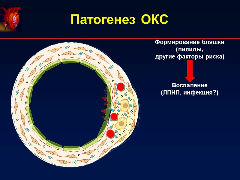 Патогенез ОКС Формирование бляшки (липиды, другие факторы риска) Воспаление Патогенез ОКС Формирование бляшки (липиды, другие факторы риска) Воспаление